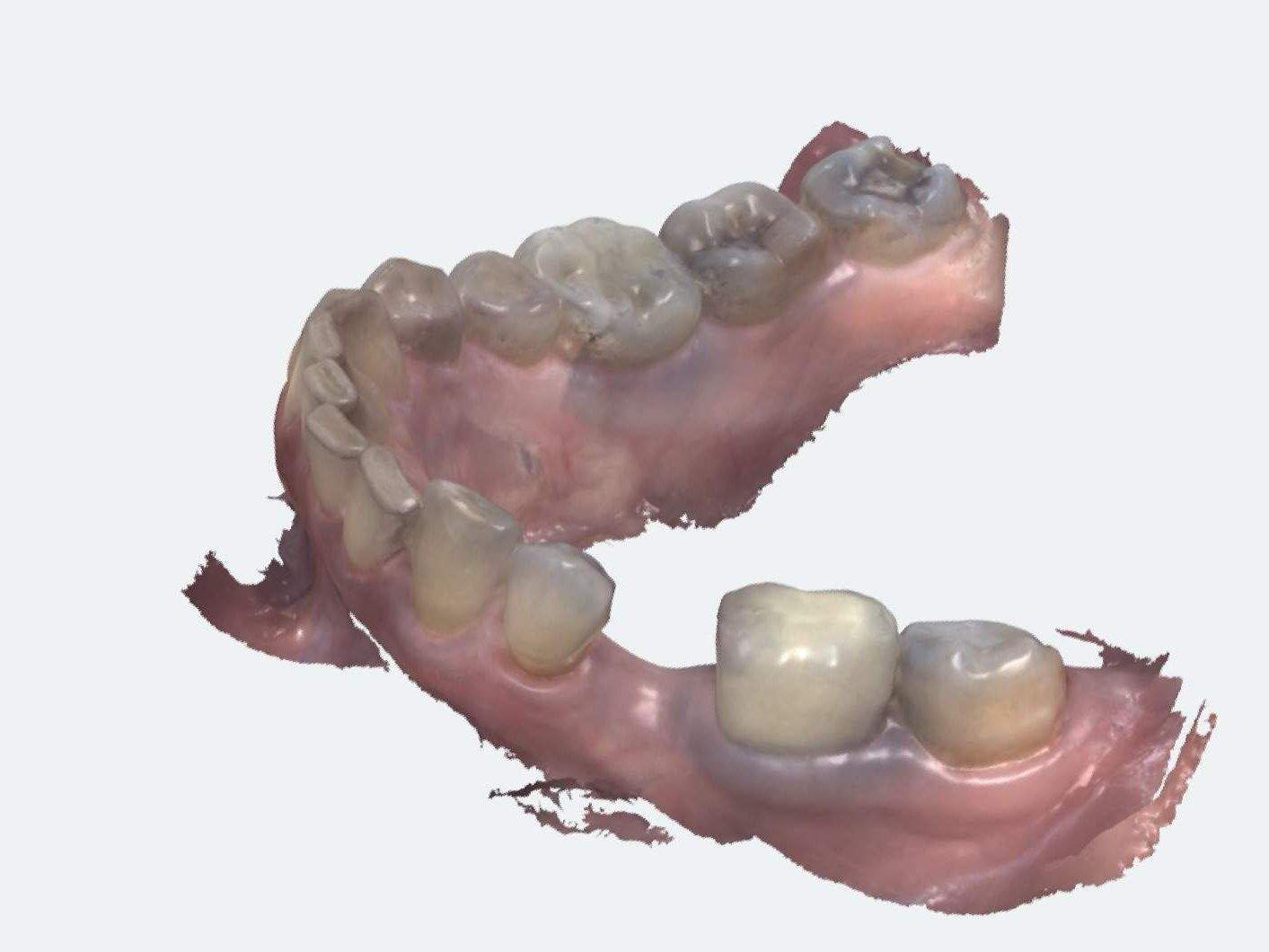 Εμφυτεύματα δοντιών Αθήνα Χολαργός Παπάγου, εμφυτεύματα χωρίς πόνο, άριστο αποτέλεσμα, Εμφύτευμα δοντιού σε μία ημέρα