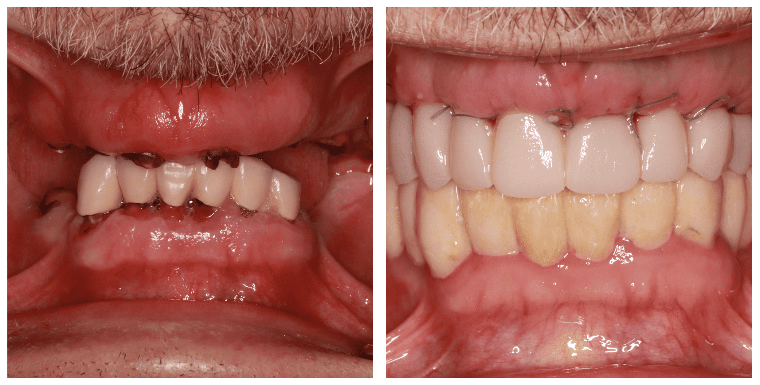 Εμφυτεύματα δοντιών σε μία μέρα με άμεση αποκατάσταση